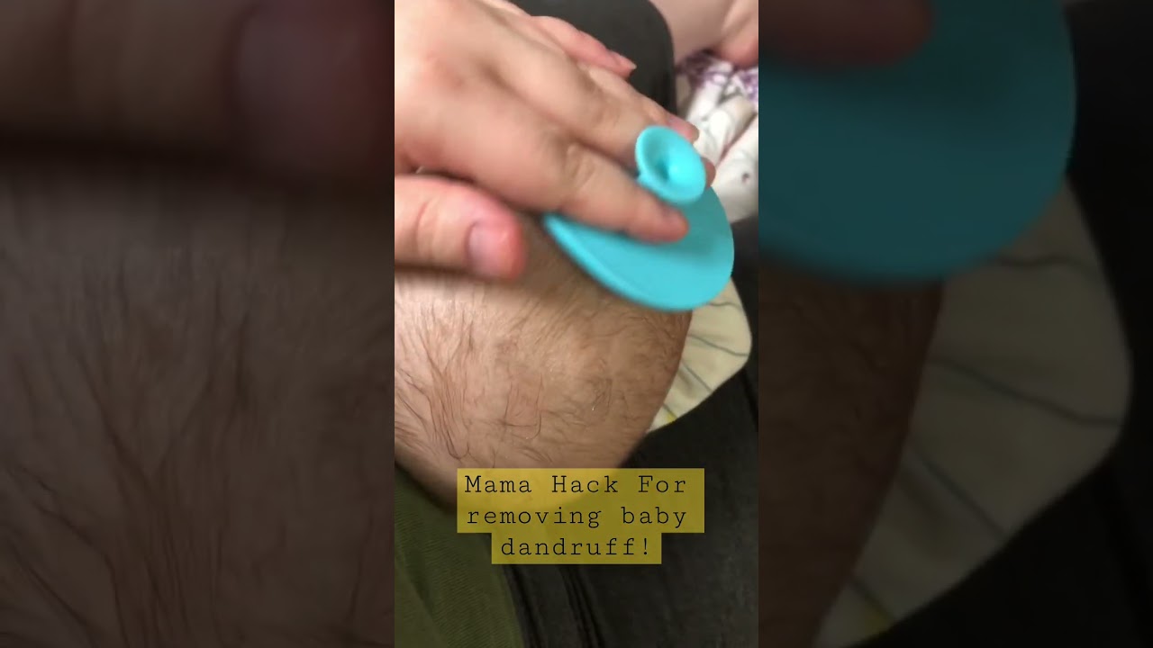 Baby hack for dandruff! 
