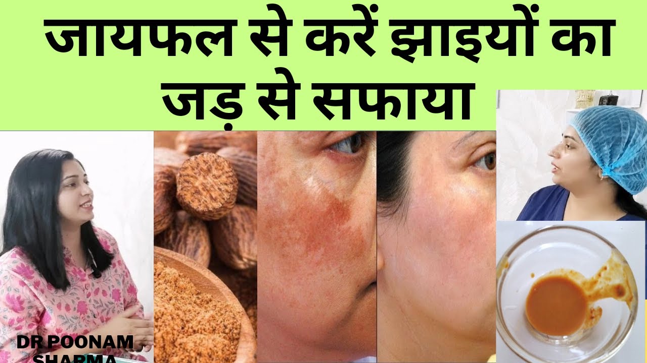झाइयों को करे जड़ से ख़त्म जायफल के इस घरेलु नुस्खे से | Pigmentation Ka Gharelu Ilaaj |