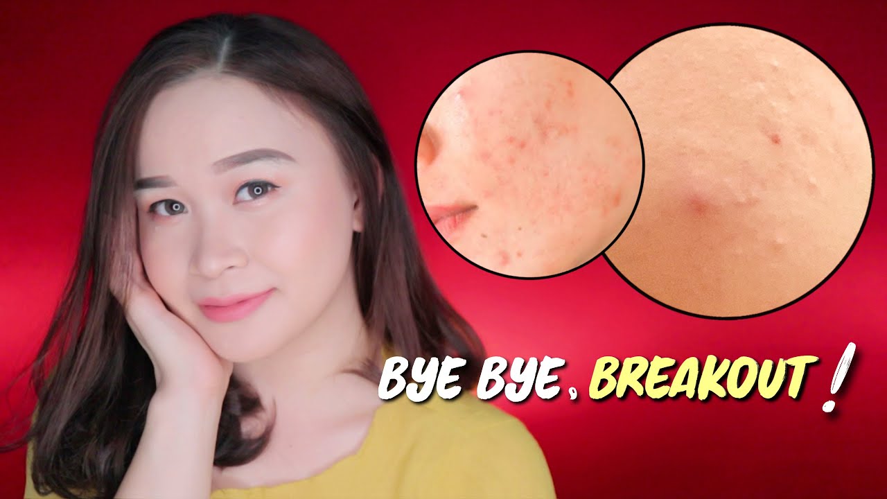 4 Cara CEPAT HILANGKAN BREAKOUT akibat NGGAK COCOK SKINCARE.