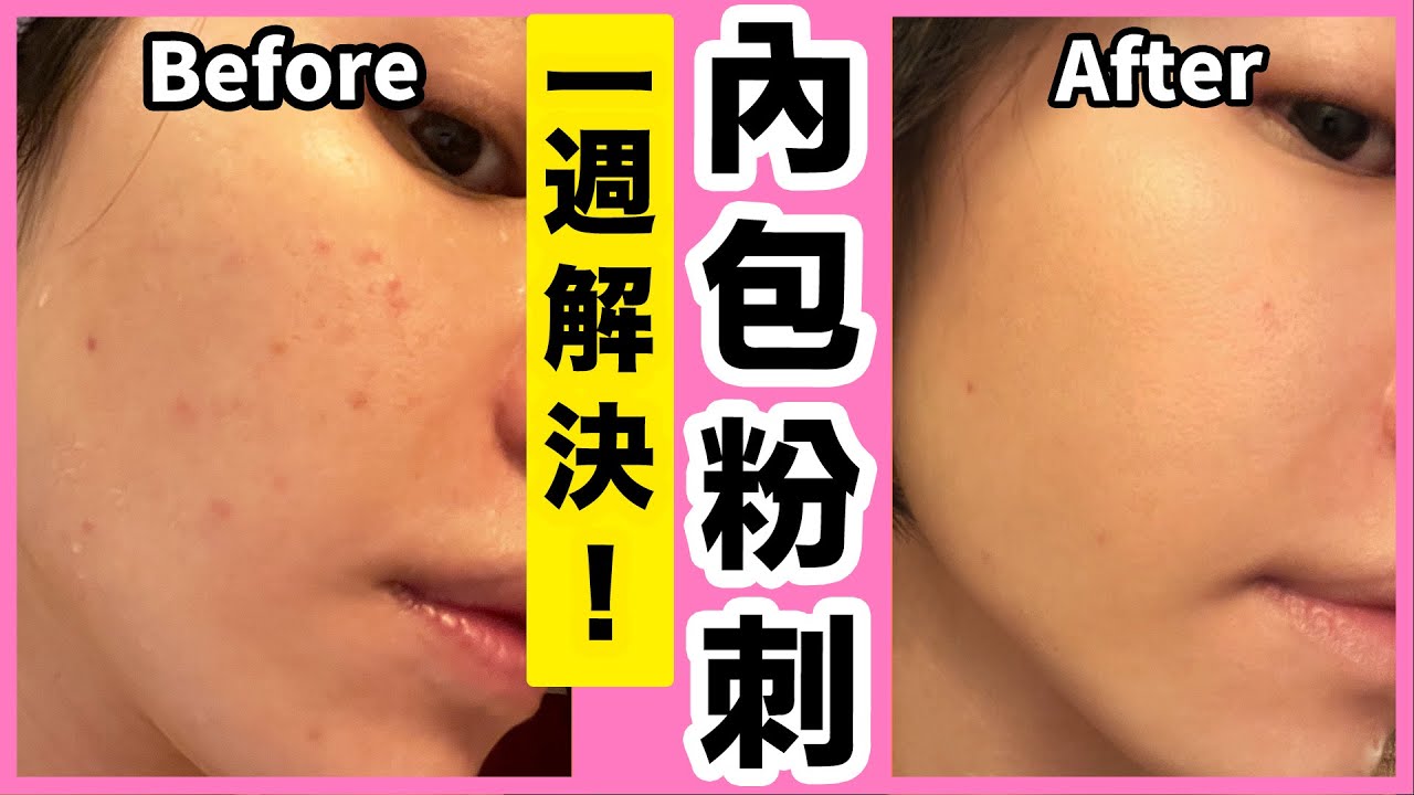 一週解決內包粉刺！