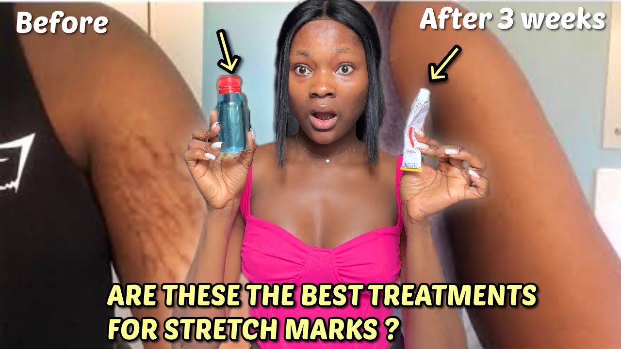 The best stretch mark Treatment ever! | Best topical stretch mark treatment #tretinoin #stretchmarks