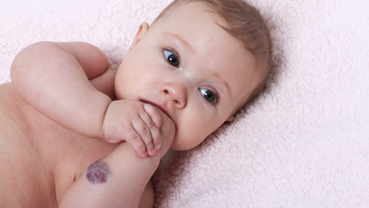 What is a hemangioma? Nemours KidsHealth