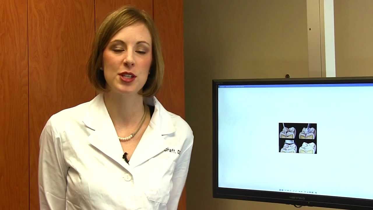 What is a Sealant? Austin Dentist Dr. Emily Craft, Pecan Park Smile Family Dentistry