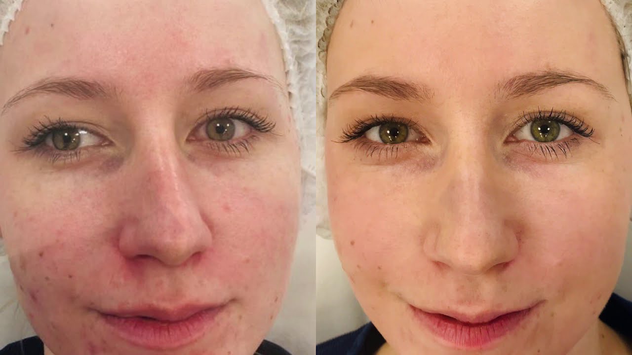 Hollywood Peel czyli laserowy peeling węglowy wykonany laserem pikosekundowym ⚡️ Pico Plus ⚡️