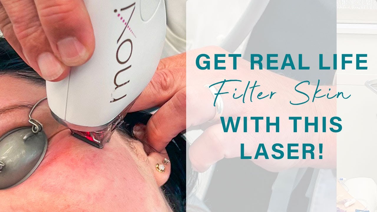 The Laser that gives you Filter Skin! | MOXI Laser