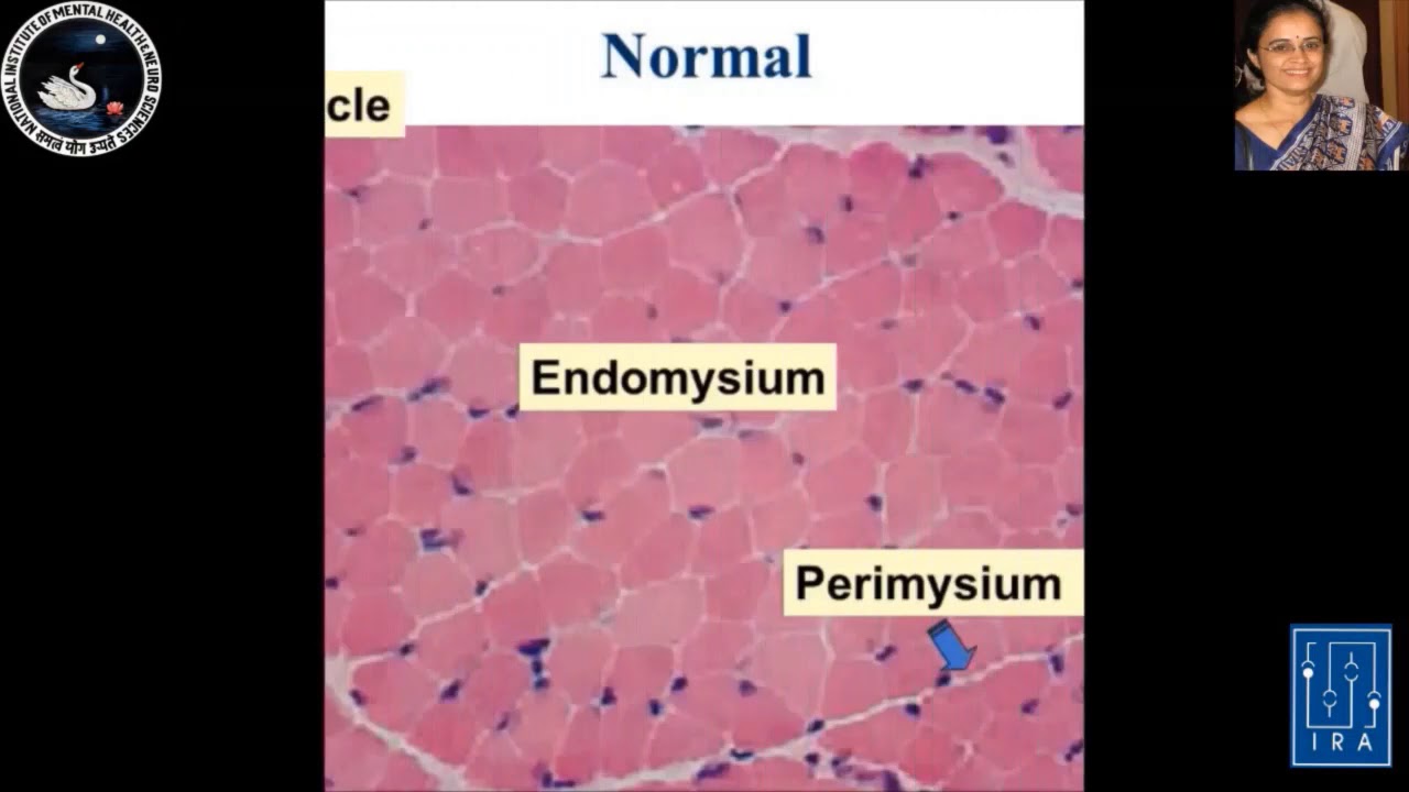 What A Clinician Needs to Know? Essentials of Muscle Biopsy Interpretation Part I