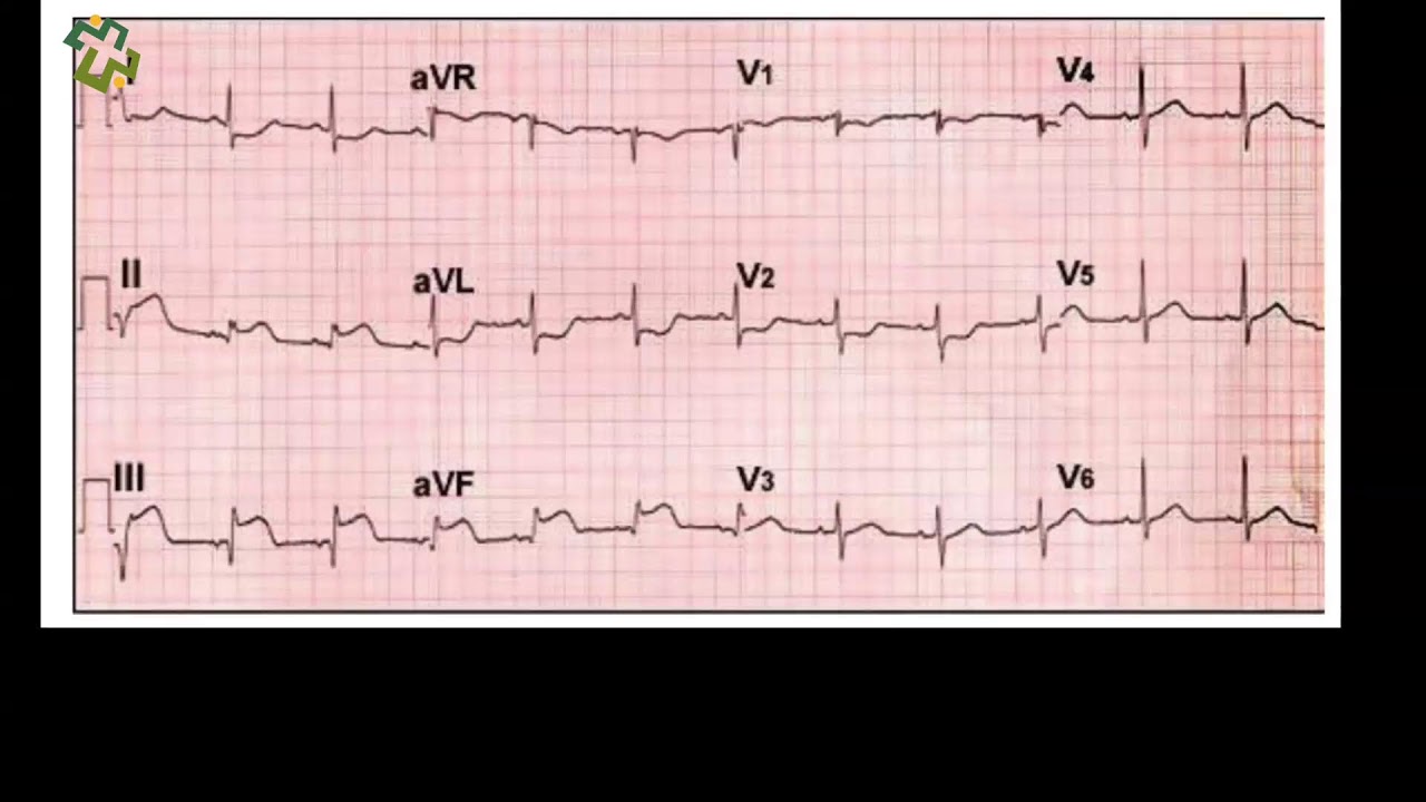Think Like a Physician: Approach to ECGs: Quick-Fire