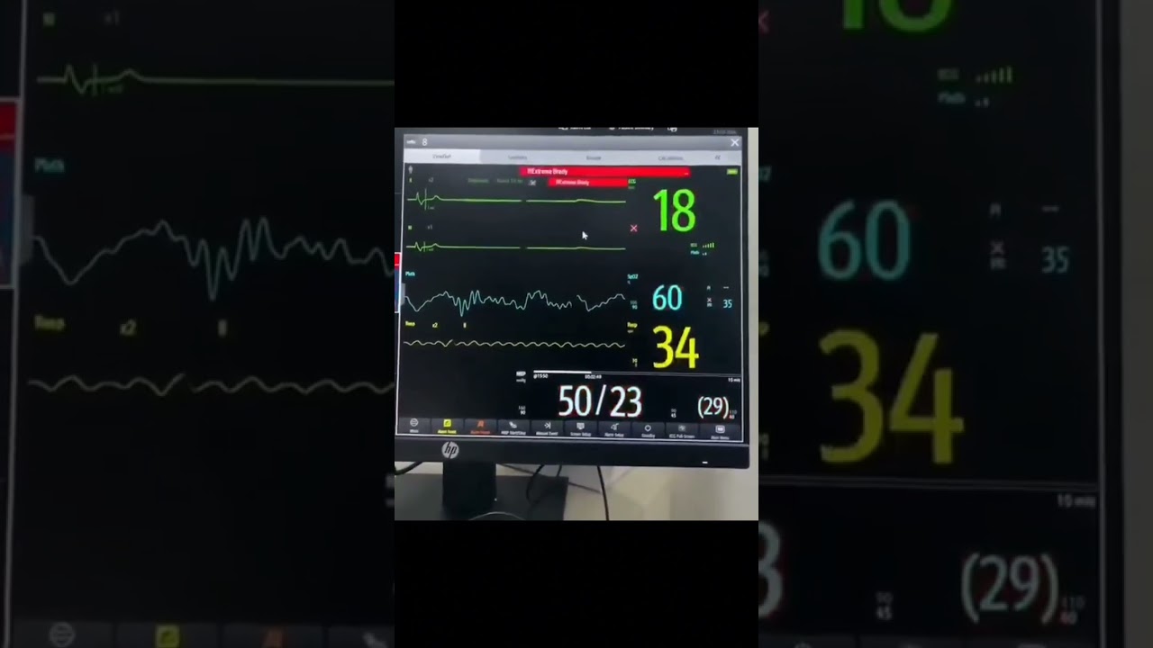 Final Moment: A Patient's Last Breath On The Patient's Monitor 🥀
