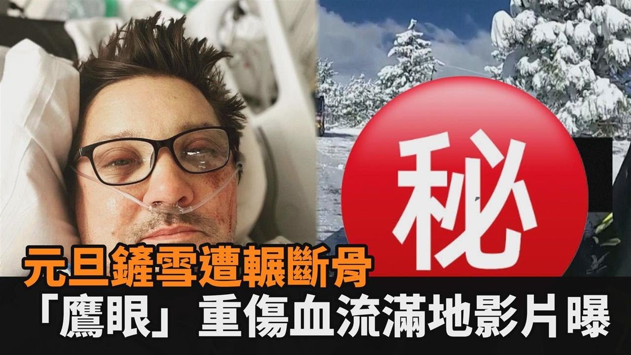 元旦鏟雪遭輾斷骨！「鷹眼」重傷血流滿地影片曝　醫護稱：臉腫如壘球－全民話燒