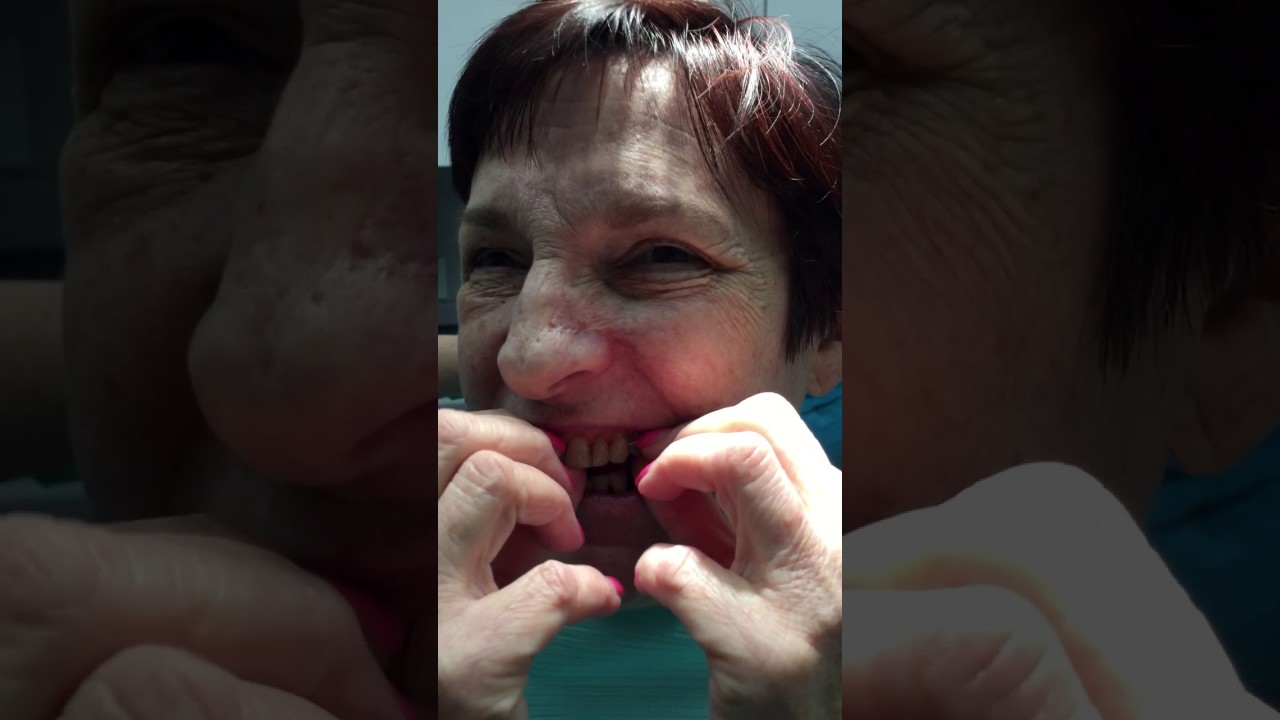 Interim Obturator - Patient instructions - cancer denture for upper jaw