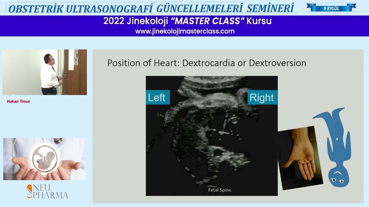 Ultrasonogorafik Fetal Kardiyak Tarama / Doç.Dr. Hakan Timur
