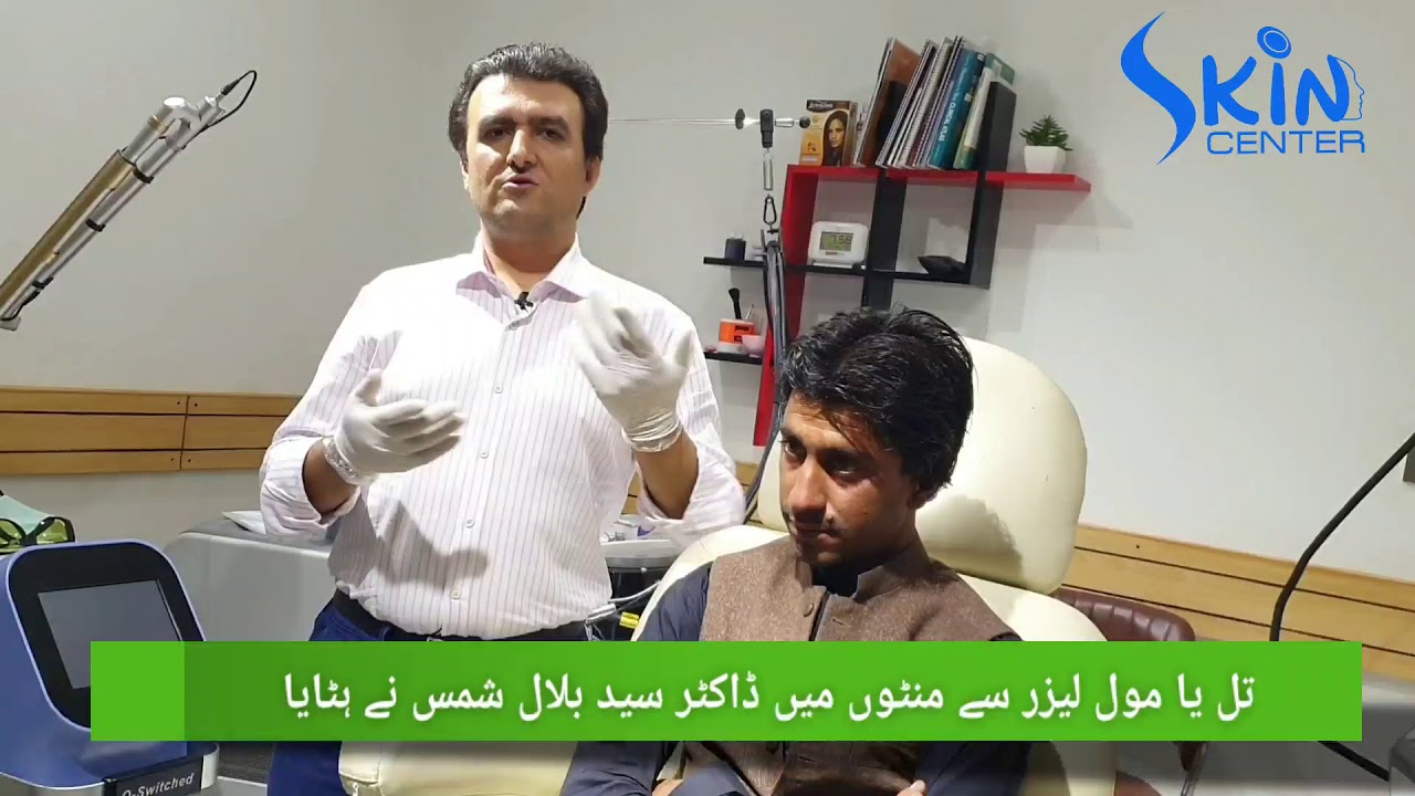 Mole removal by Laser at Skin center jinnah road corner Quarry road by Dr Syed Bilal Shams
