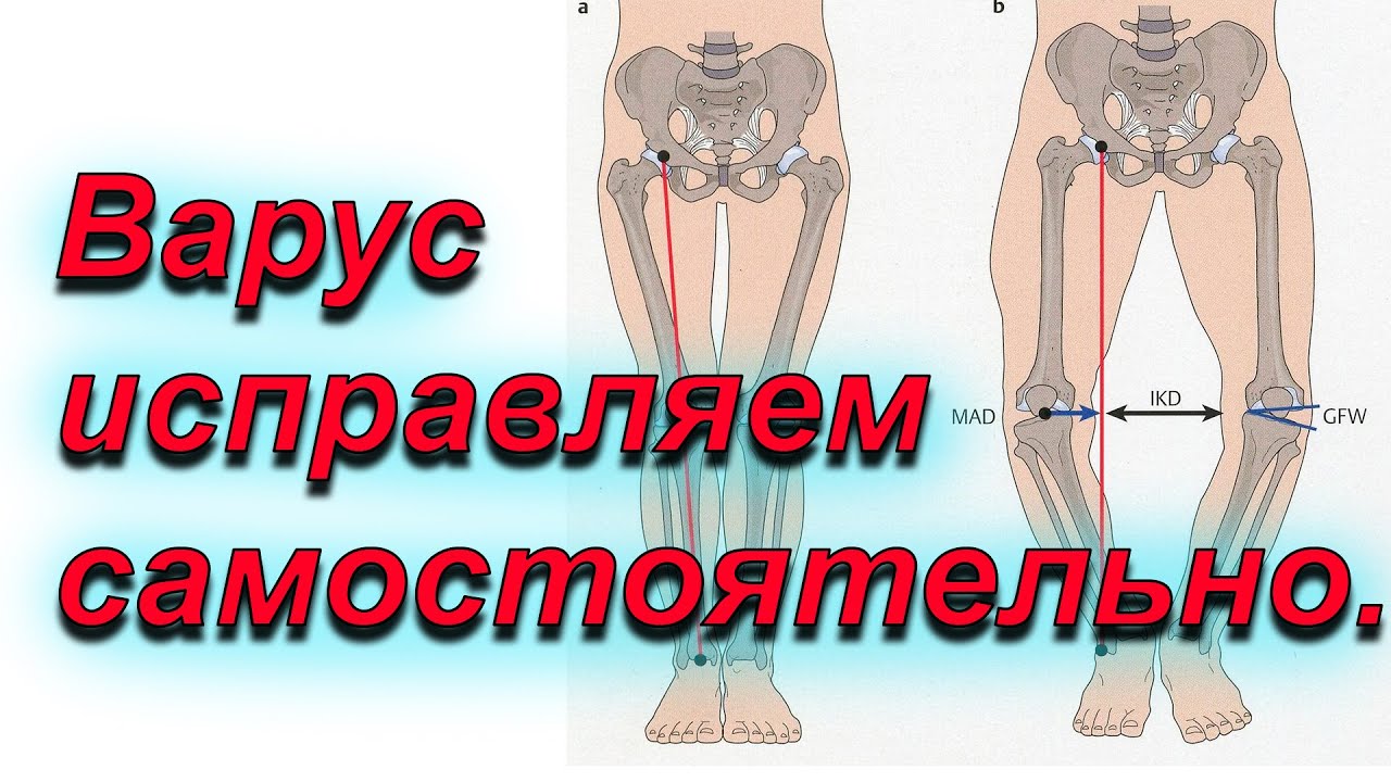 Исправляем кривые ноги.Варус.Упражнения.