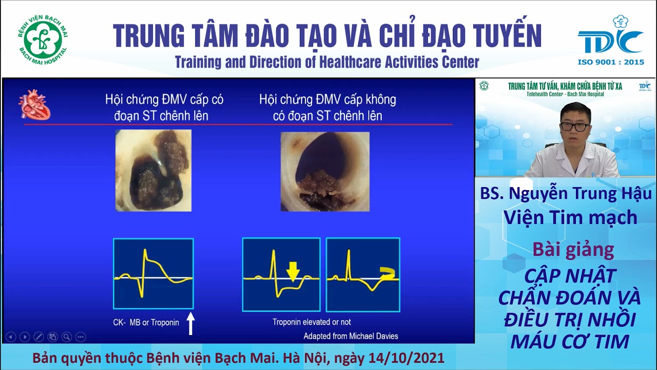 Cập nhật chẩn đoán và điều trị nhồi máu cơ tim