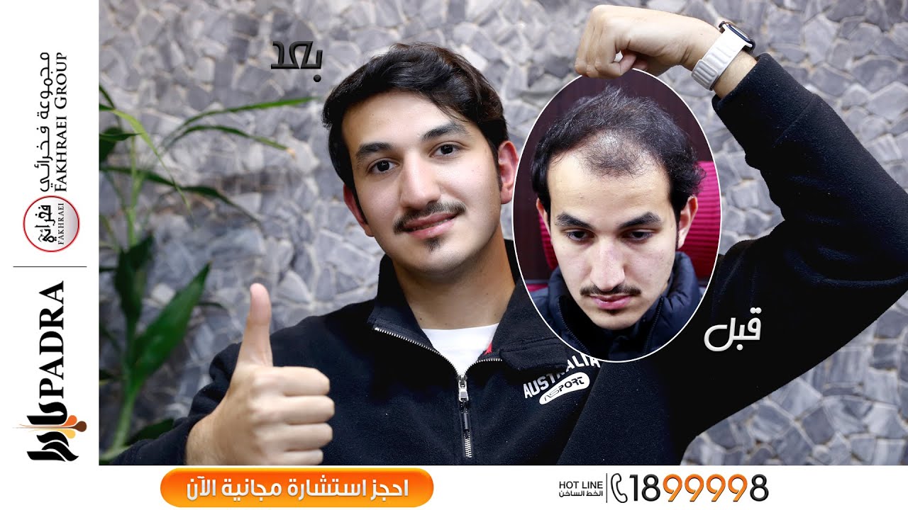 النتيجة القوية للعميل فارس بعد اختيار مركز بادرا لزراعة الشعر