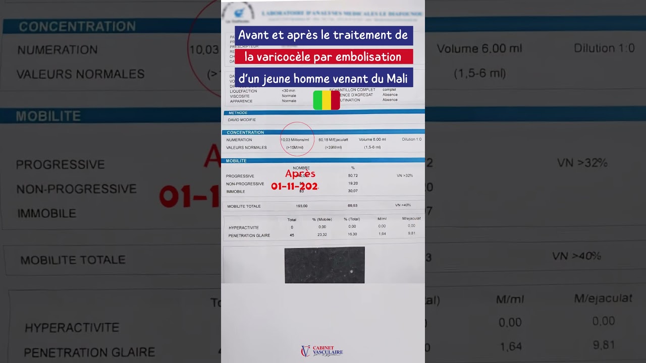 Avant et apr&egrave;s le traitement des varicoc&egrave;les par embolisation