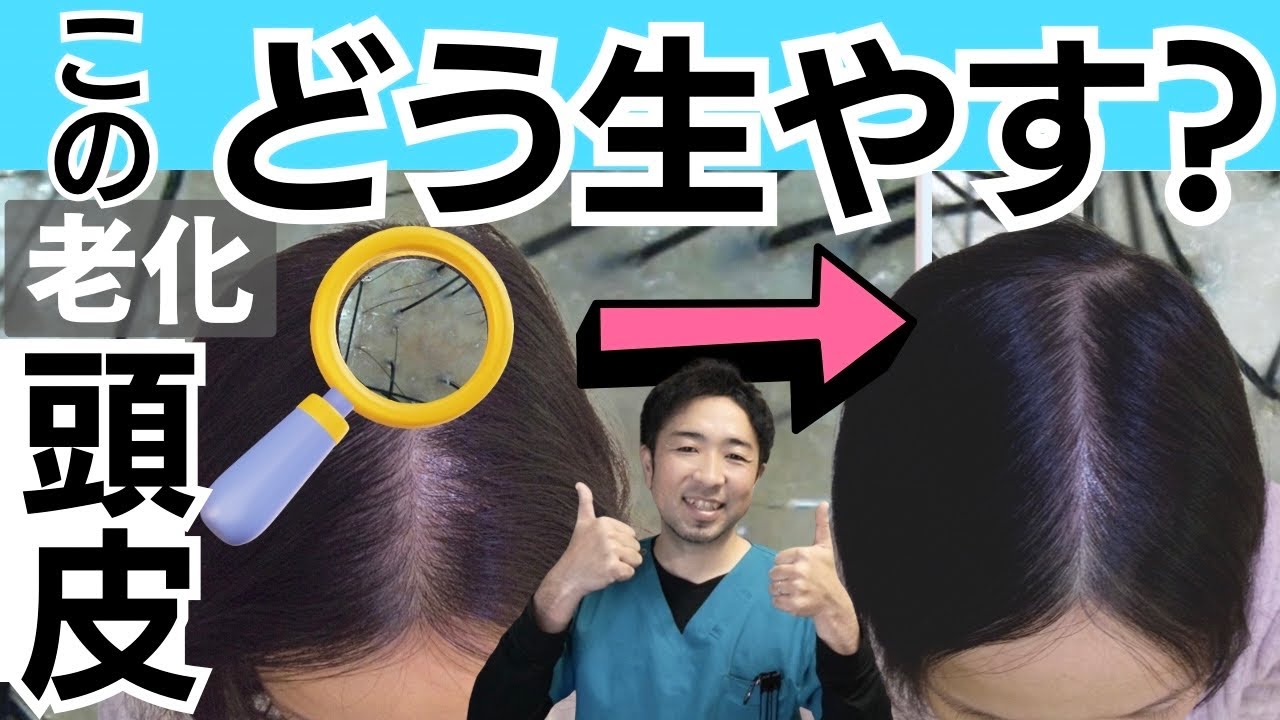 【重要】この2つの頭皮は本当に生えにくい！ミノキシジル外用薬が必須な最も老化した頭皮とは？女性の薄毛改善にミノキシジルは必須なのか？
