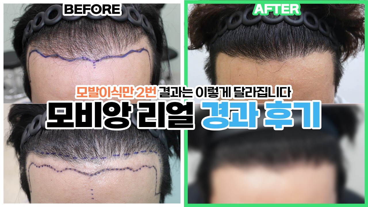 두 번의 모발이식, 과연 만족했을까? I 압구정모비앙의원_경과모음