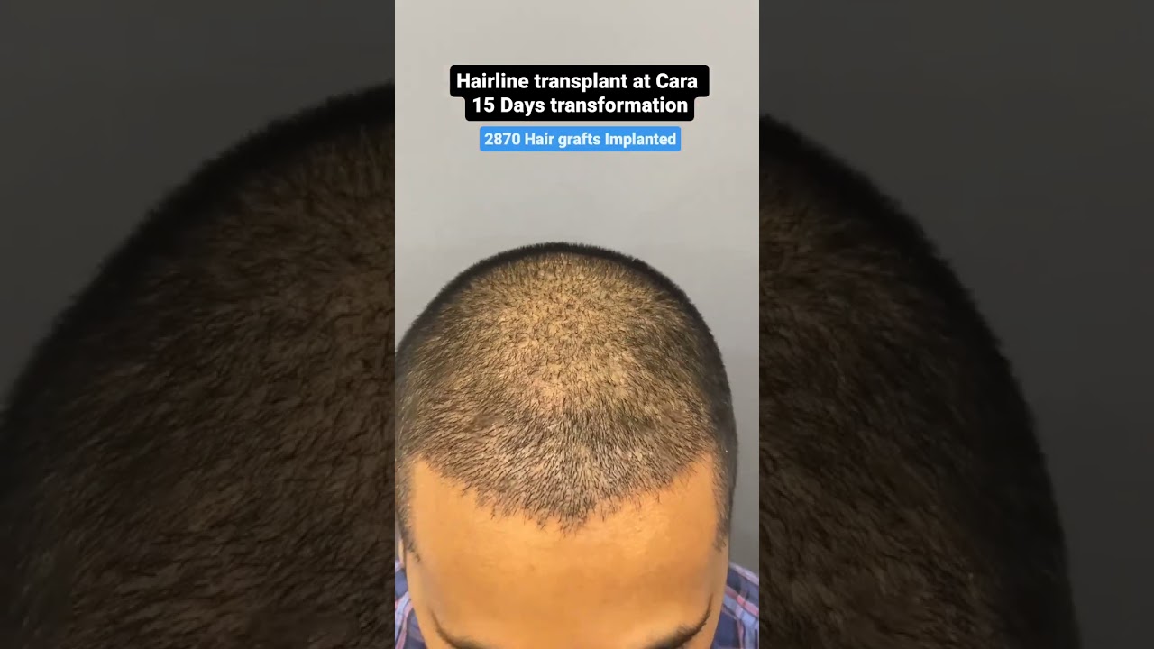 15 DAY TRANSFORMATION: See His Hair Before and After Sapphire FUE Hair Transplant