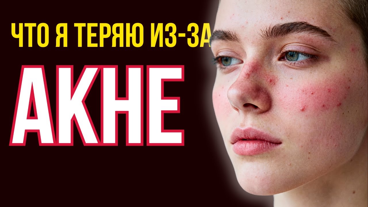 Расщепление я ≠ моё тело: когда акне становится психологической проблемой