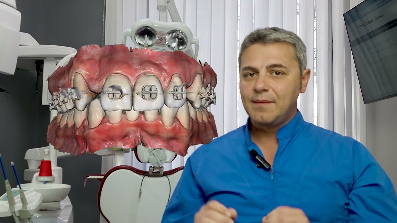 Come evitare di togliere un dente con l'apparecchio fisso (Ep. 6)