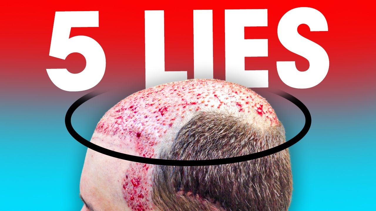 The 5 Lies that will Ruin Your Hair Transplant