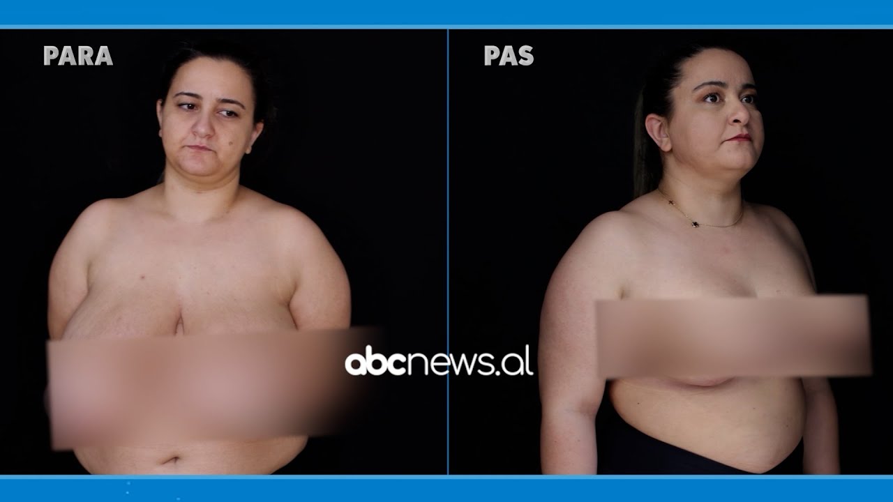 “Nuk vishja rroba banjoje, mbaja bluzë në plazh”, 36 vjeçarja zvogëlon gjoksin në “Doktor Plastik”