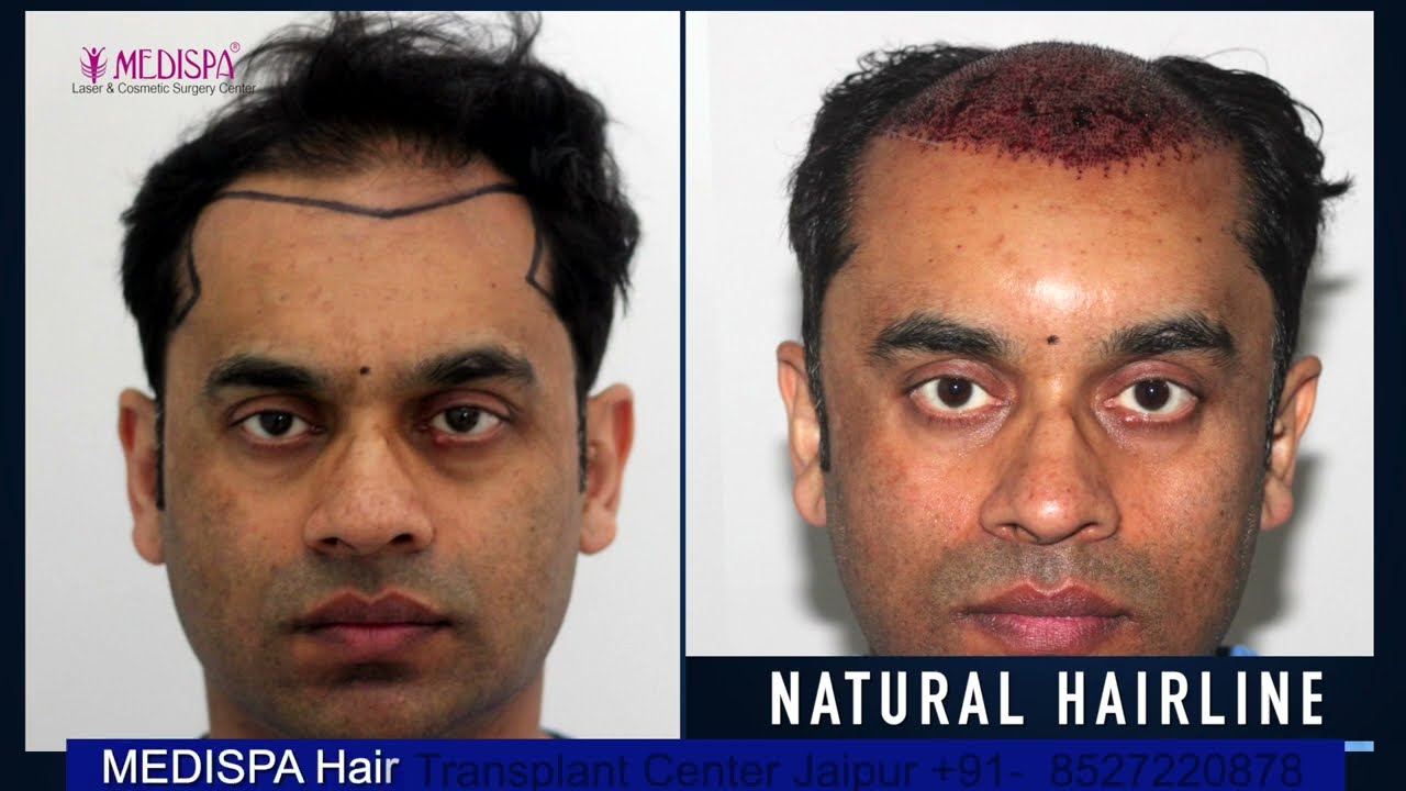 5 Year Post Hair Transplant Results | UK Doctor gets 5000 Grafts by Dr Suneet Soni