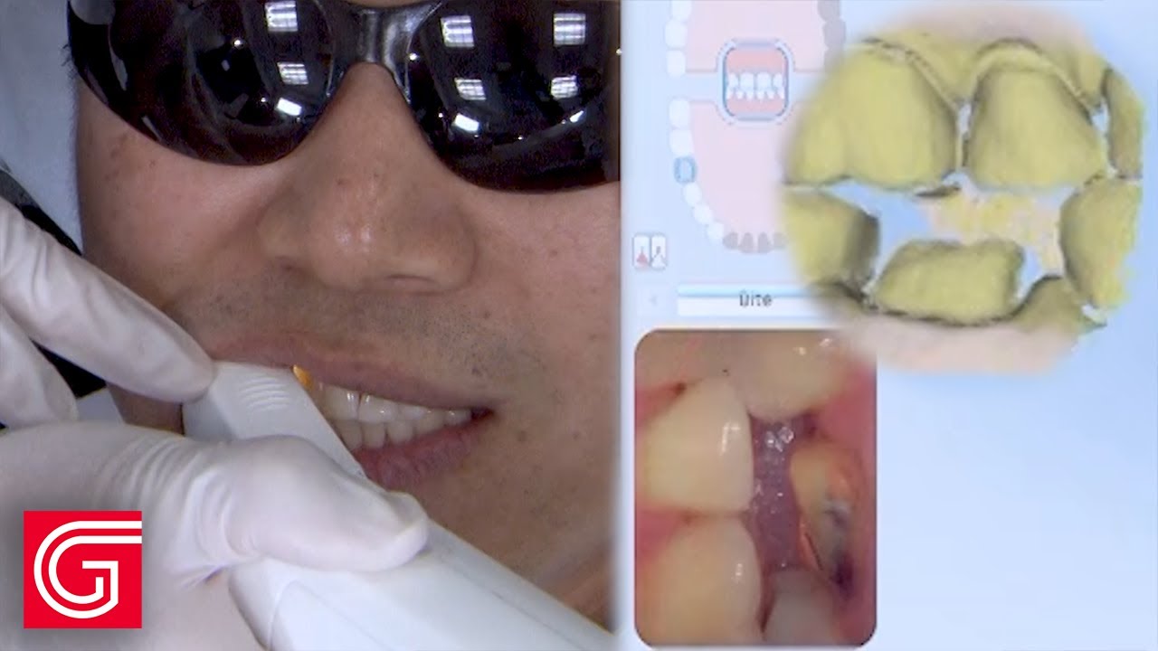 Cómo escanear una preparación molar inferior correctamente