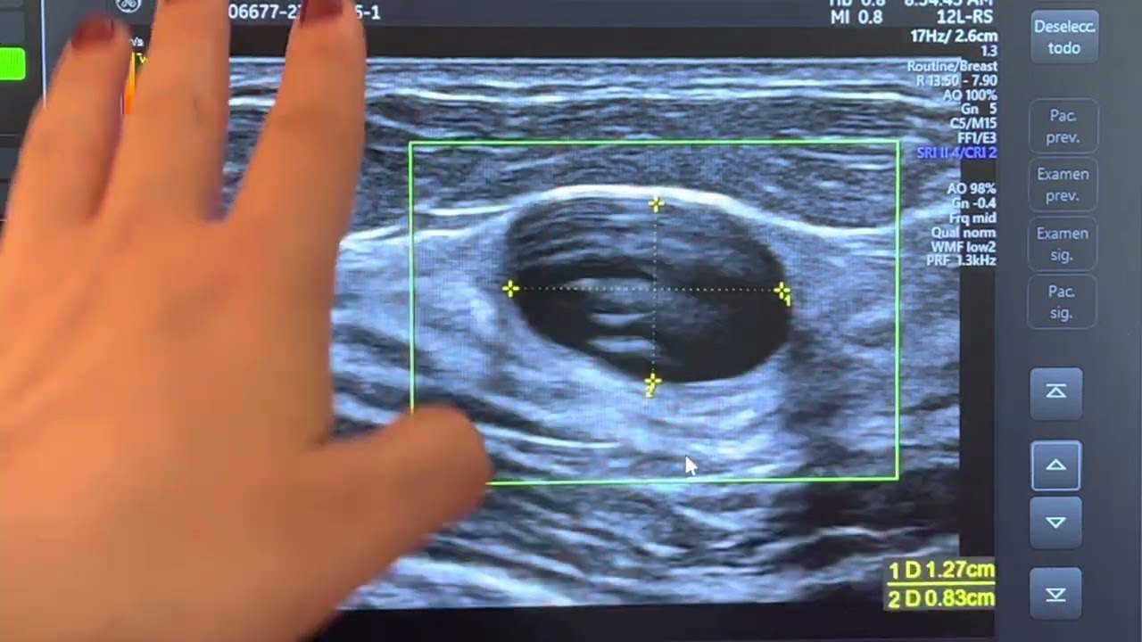 Distingue un Quiste de mama y un Fibroadenoma por ultrasonido
