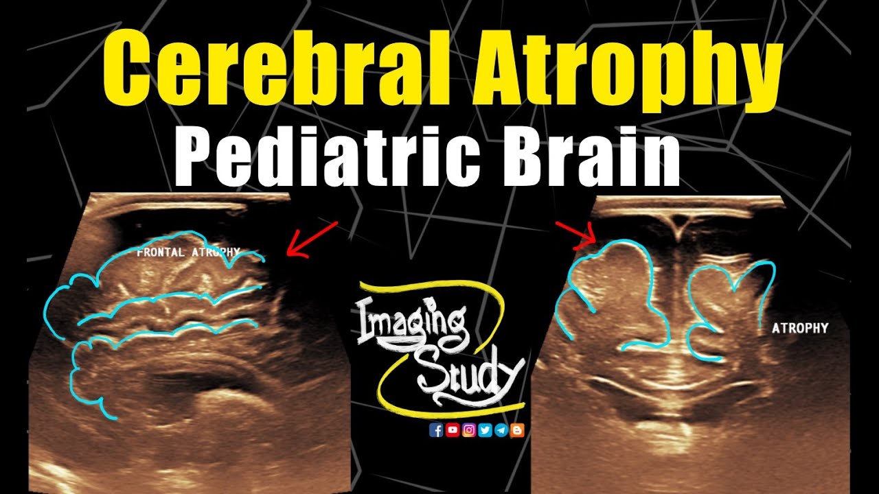 Cerebral Atrophy || Pediatric Brain || Ultrasound || Case 257
