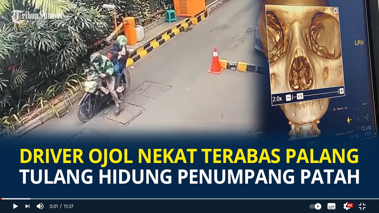 Viral Driver Ojol Nekat Terabas Palang Parkir hingga Tulang Hidung Penumpang Patah