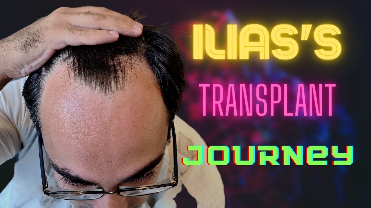 Ilias's Hair Transplant Journey in Istanbul, Turkey with Dr Balwi and Elithair