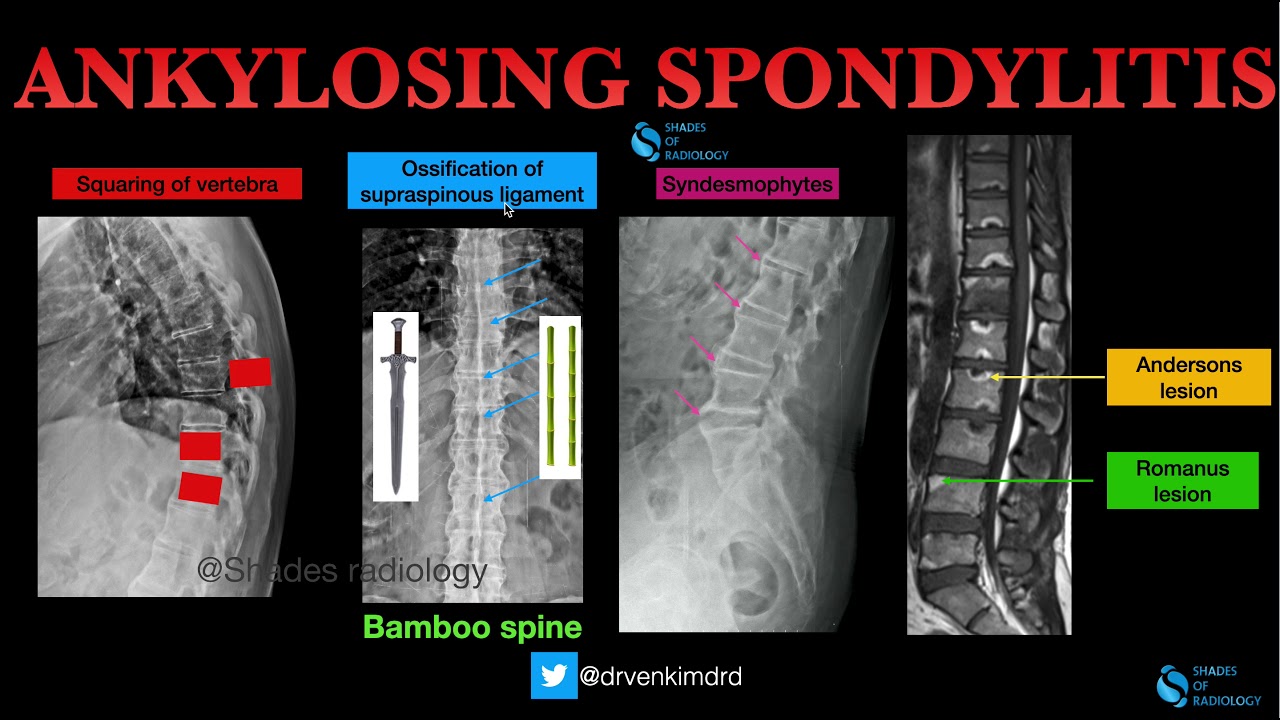 Ankylosing Spondylitis- Classic Imaging features