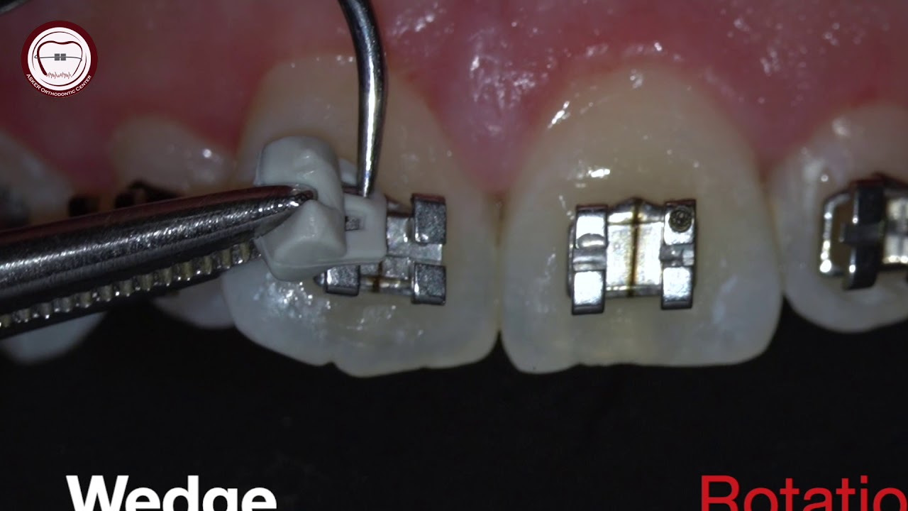 Rotational wedge in orthodontics by Amr Asker on apple store application