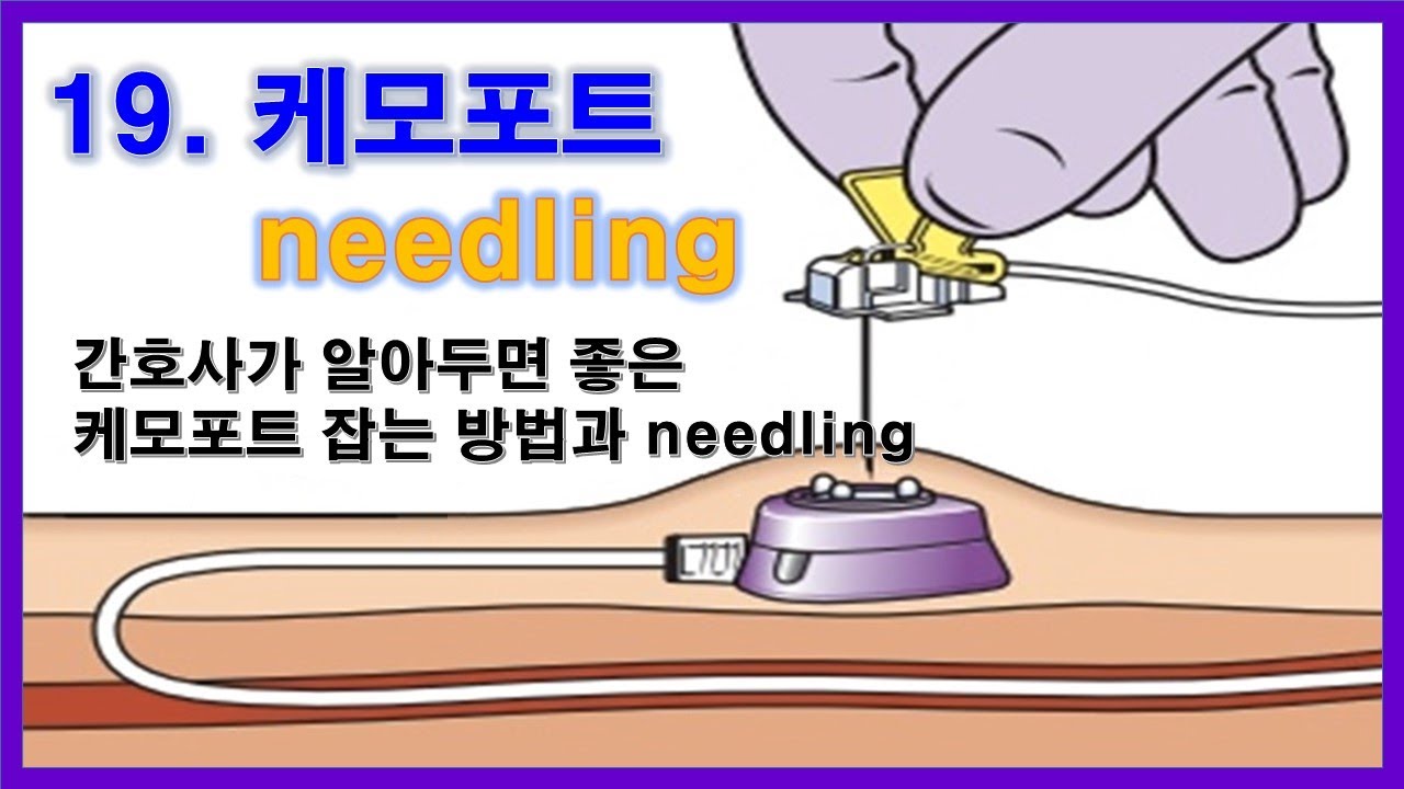 19. 케모포트 needling - 간호사가 알아두면 좋은 chemoport 잡는 방법과 needling.