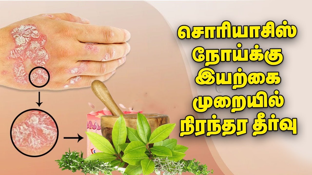 Psoriasis நோய்க்கு Steroid இல்லாத இயற்கை முறையில் நிரந்தர தீர்வு | Nalam 360 | Dr.அமுதா தாமோதரன்