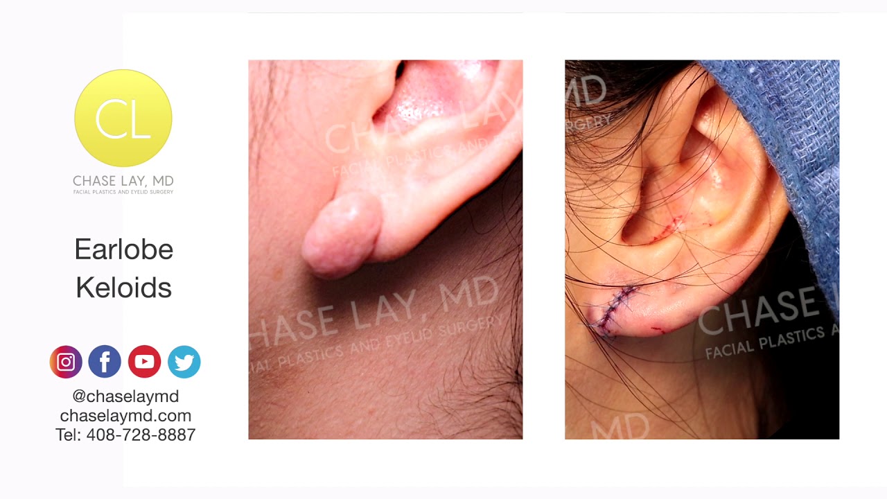 #ChaseLayMD Explains Earlobe Keloid Removal