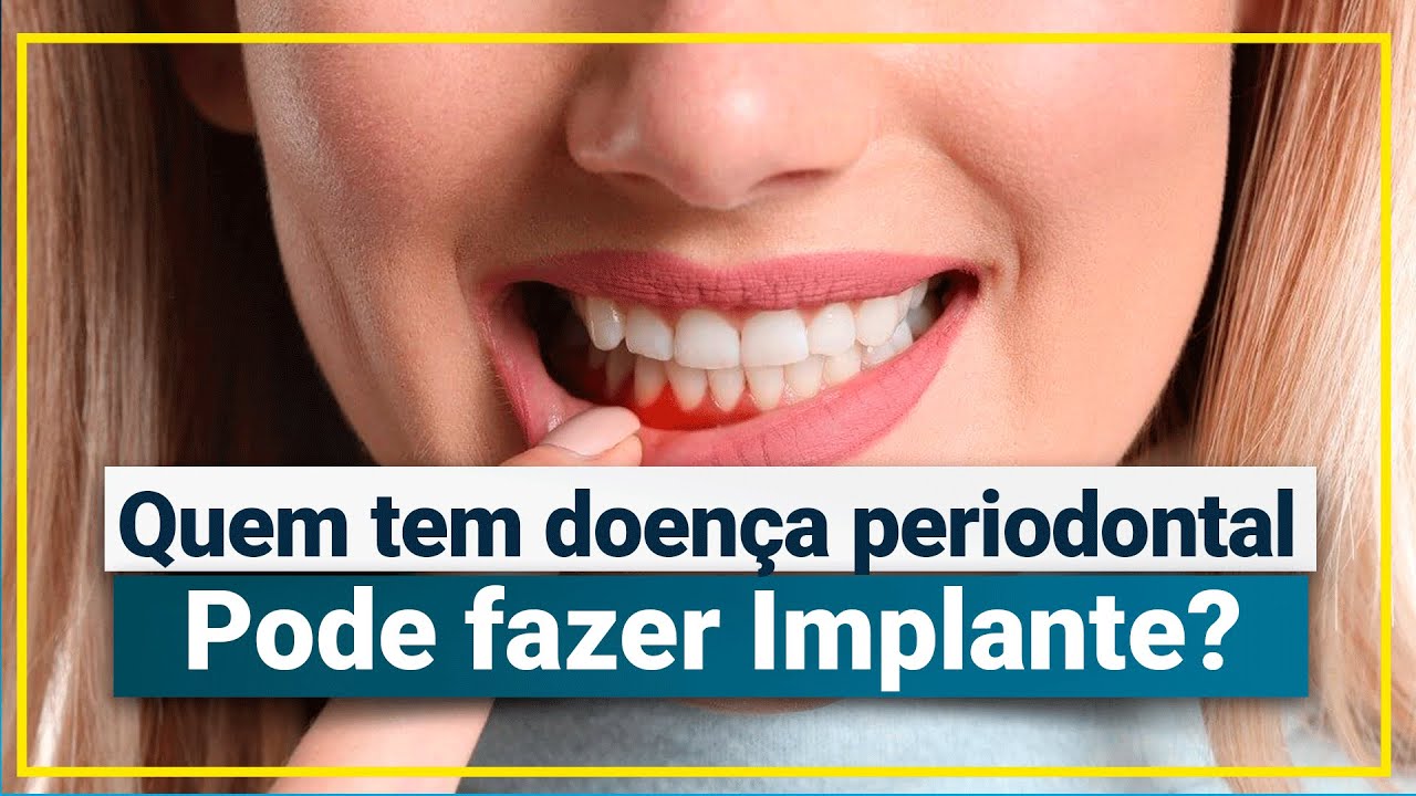 Quem tem DOENÇA PERIODONTAL pode fazer IMPLANTE DENTÁRIO?