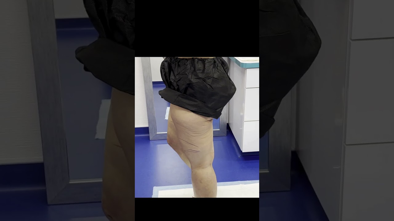 One Leg Transformed! 😱 See the INSANE Before & After from 360&deg; Cankle Lipo! | Tampa, Florida