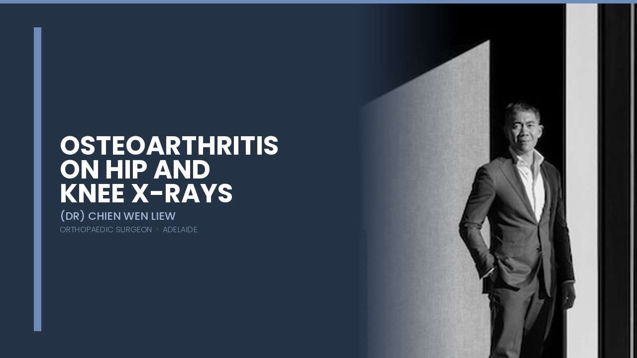 Osteoarthritis on Xrays of Hip and Knee
