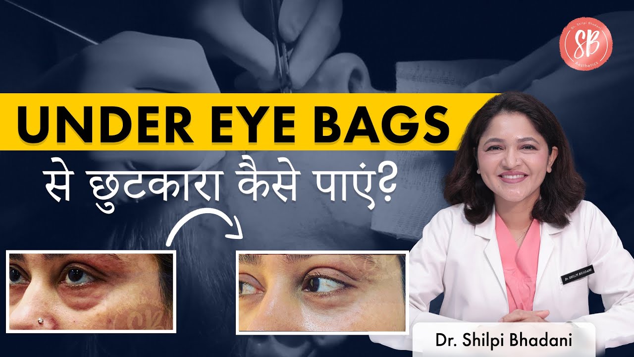 Under eye bags कैसे हटाएं? | Eyelid Surgeon in Gurgaon | Dr. Shilpi Bhadani | Dr. Shilpi Bhadani