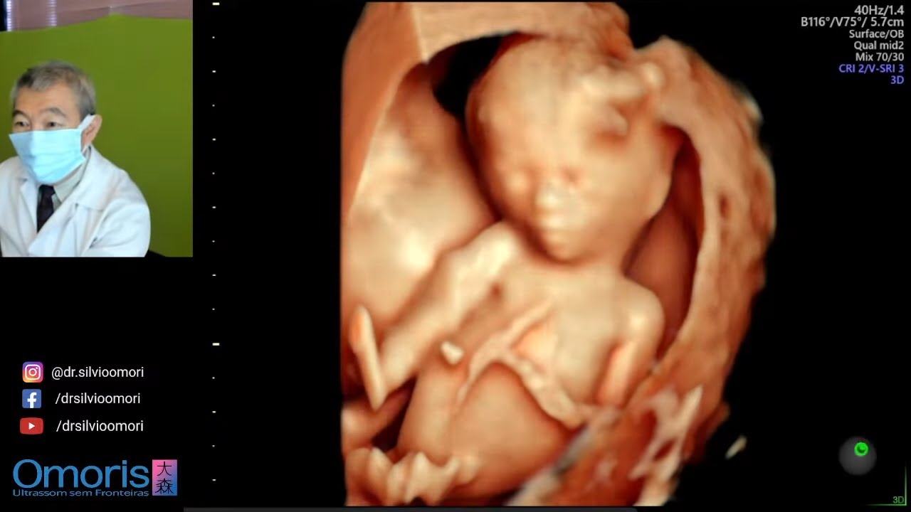 Menino ou menina? - Ultrassom 13 semanas