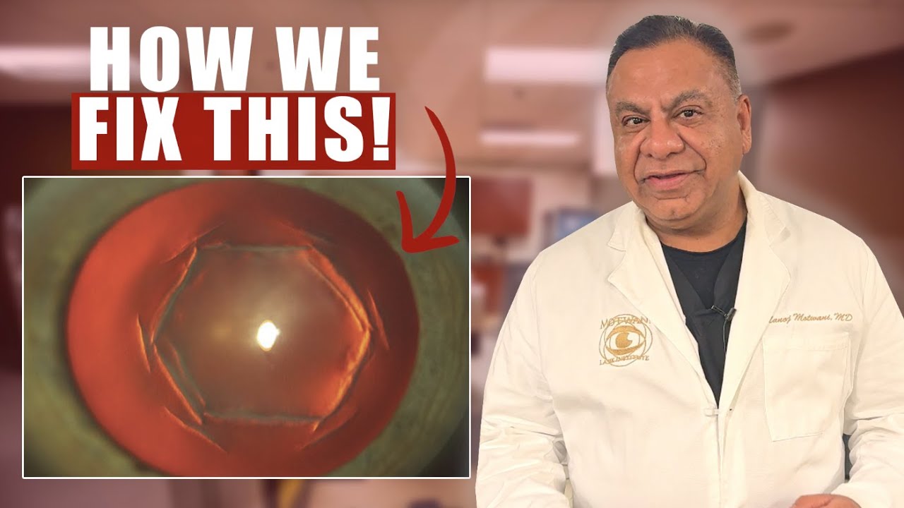 Can We Treat A Prior Hexagonal Keratotomy?