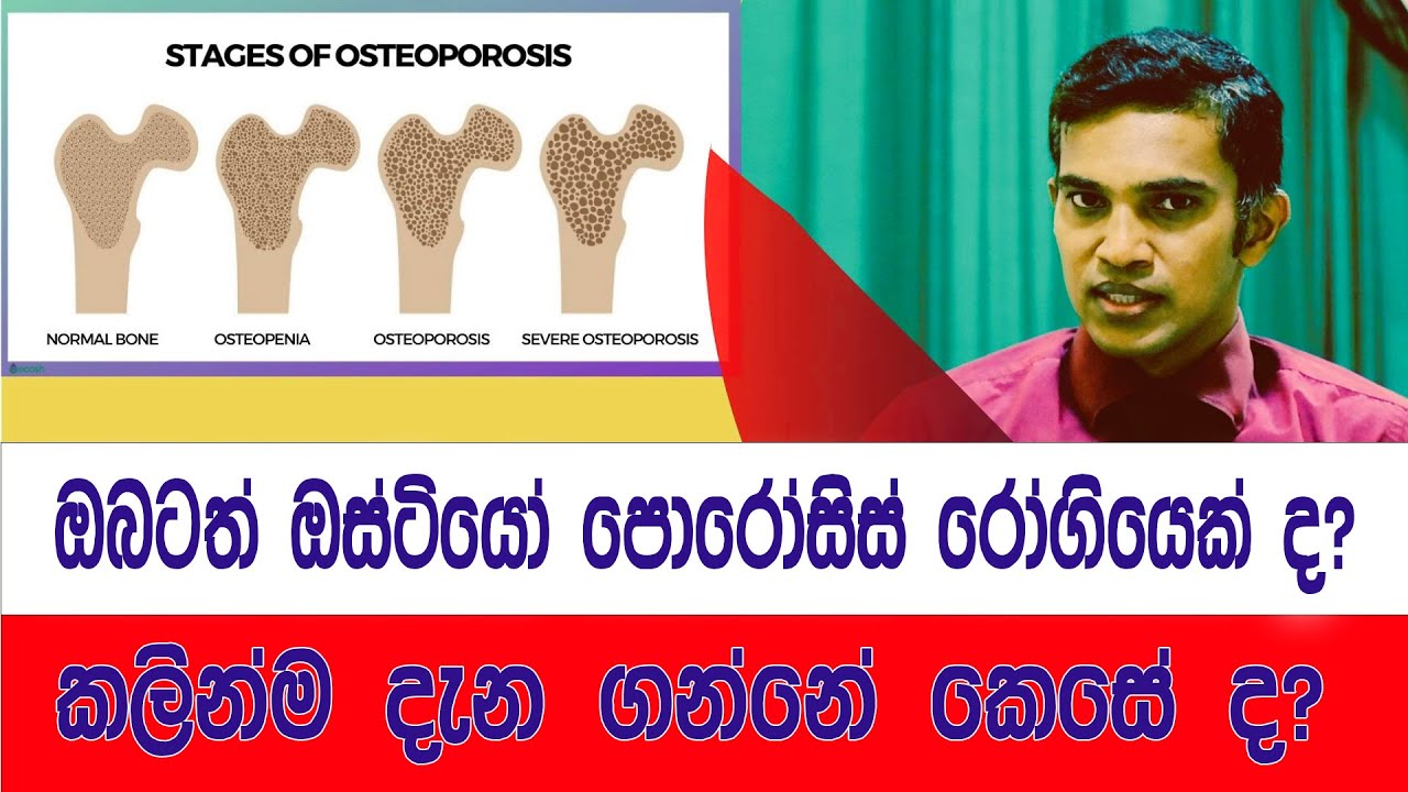 ඔබත් ඔස්ටියෝ පුරෝසිස් රෝගියෙක්ද  ? දැන්ම දැනගන්න වීඩියෝව නරඹන්න