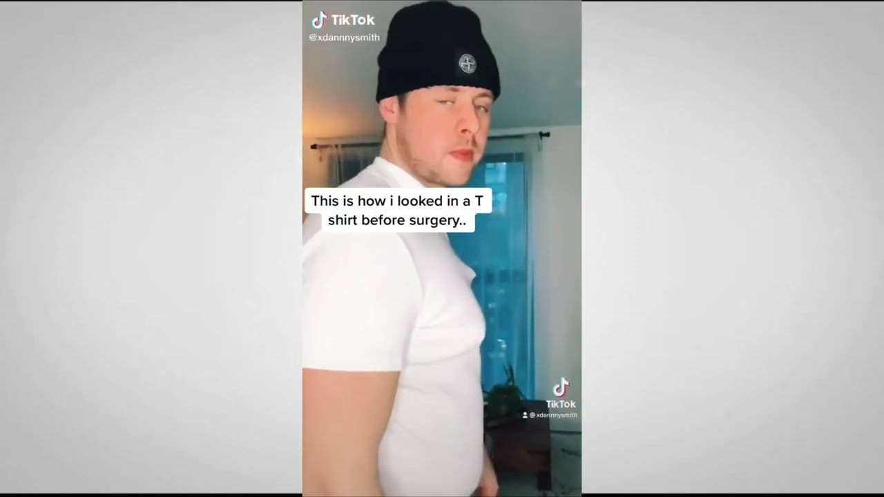 Gynecomastia Surgery Transformation Danny Smith | Dr Hassan Nurein
