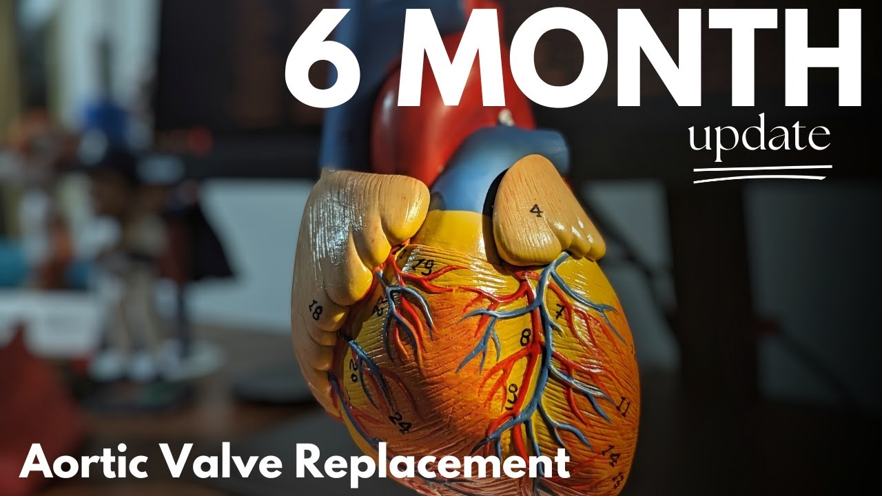 6 Month Update - Post Aortic Valve Replacement Surgery