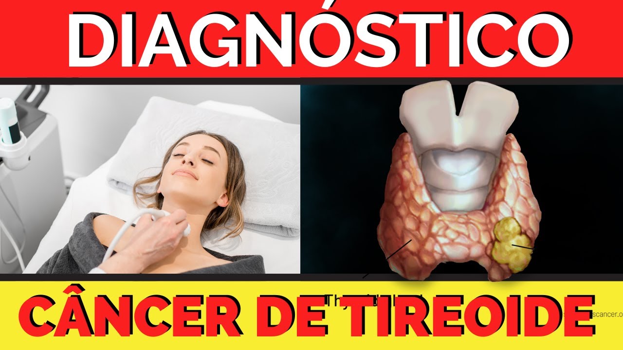 COMO É O DIAGNÓSTICO DO CÂNCER DE TIREOIDE?