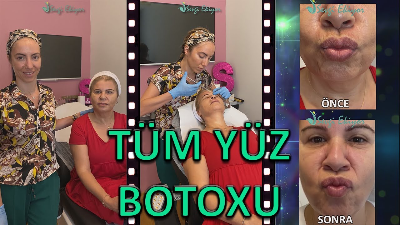 TÜM YÜZ BOTOXU
