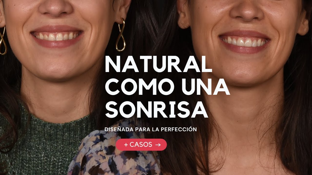 Testimonio - Diseño de sonrisa carillas dentales - By. Dr. Ferran Llansana